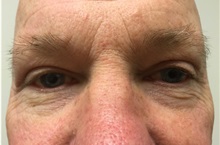 Eyelid Surgery After Photo by Darrick Antell, MD; New York, NY - Case 35045