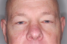 Eyelid Surgery Before Photo by Darrick Antell, MD; New York, NY - Case 35045