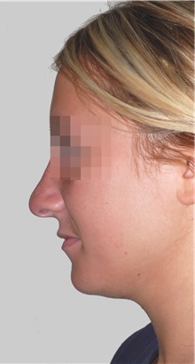 Rhinoplasty After Photo by Darrick Antell, MD; New York, NY - Case 36079