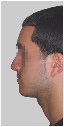 Rhinoplasty After Photo by Darrick Antell, MD; New York, NY - Case 36080