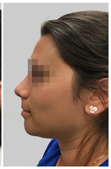 Rhinoplasty After Photo by Darrick Antell, MD; New York, NY - Case 36082