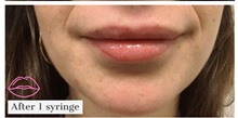 Injectable Fillers After Photo by Darrick Antell, MD; New York, NY - Case 36086