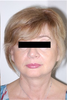 Facelift After Photo by Darrick Antell, MD; New York, NY - Case 36132