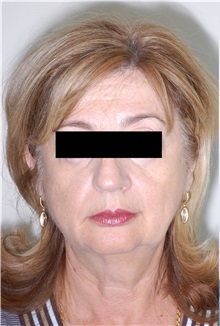 Facelift Before Photo by Darrick Antell, MD; New York, NY - Case 36132