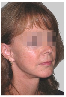 Facelift After Photo by Darrick Antell, MD; New York, NY - Case 36133