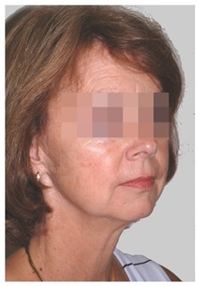 Facelift Before Photo by Darrick Antell, MD; New York, NY - Case 36133