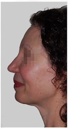 Facelift After Photo by Darrick Antell, MD; New York, NY - Case 36134