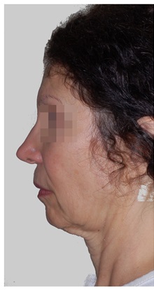 Facelift Before Photo by Darrick Antell, MD; New York, NY - Case 36134