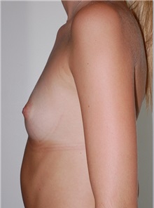 Breast Augmentation Before Photo by Darrick Antell, MD; New York, NY - Case 36136