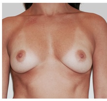 Breast Augmentation Before Photo by Darrick Antell, MD; New York, NY - Case 36139