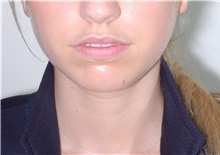 Chin Augmentation Before Photo by Darrick Antell, MD; New York, NY - Case 36143