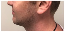 Chin Augmentation After Photo by Darrick Antell, MD; New York, NY - Case 36148