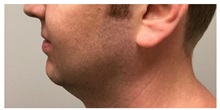 Chin Augmentation Before Photo by Darrick Antell, MD; New York, NY - Case 36148