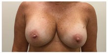 Breast Implant Revision After Photo by Darrick Antell, MD; New York, NY - Case 36152