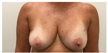 Breast Implant Revision Before Photo by Darrick Antell, MD; New York, NY - Case 36152