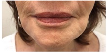 Chemical Peels, IPL, Fractional CO2 Laser Treatments After Photo by Darrick Antell, MD; New York, NY - Case 36218