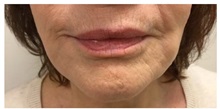 Chemical Peels, IPL, Fractional CO2 Laser Treatments Before Photo by Darrick Antell, MD; New York, NY - Case 36218