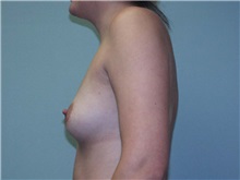 Breast Augmentation Before Photo by Richard Greco, MD; Savannah, GA - Case 2222