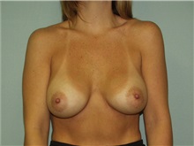 Breast Augmentation After Photo by Richard Greco, MD; Savannah, GA - Case 2259