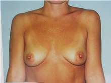 Breast Augmentation Before Photo by Richard Greco, MD; Savannah, GA - Case 2259