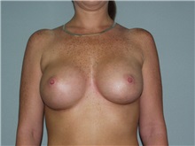 Breast Augmentation After Photo by Richard Greco, MD; Savannah, GA - Case 2374