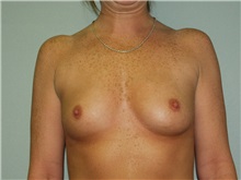 Breast Augmentation Before Photo by Richard Greco, MD; Savannah, GA - Case 2374