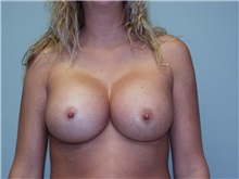 Breast Augmentation After Photo by Richard Greco, MD; Savannah, GA - Case 2410