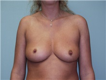 Breast Augmentation Before Photo by Richard Greco, MD; Savannah, GA - Case 2410