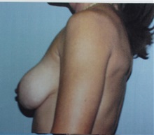 Breast Augmentation Before Photo by Richard Greco, MD; Savannah, GA - Case 2428