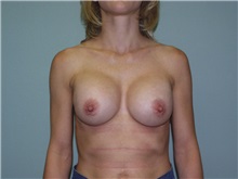 Breast Augmentation After Photo by Richard Greco, MD; Savannah, GA - Case 2446