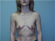 Breast Augmentation Before Photo by Richard Greco, MD; Savannah, GA - Case 2446