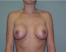 Breast Augmentation After Photo by Richard Greco, MD; Savannah, GA - Case 2519