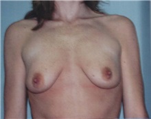 Breast Augmentation Before Photo by Richard Greco, MD; Savannah, GA - Case 2519
