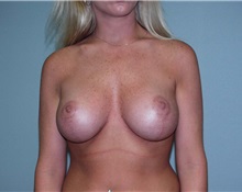 Breast Augmentation After Photo by Richard Greco, MD; Savannah, GA - Case 2538