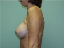 Breast Augmentation After Photo by Richard Greco, MD; Savannah, GA - Case 2557