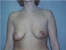Breast Augmentation Before Photo by Richard Greco, MD; Savannah, GA - Case 2595