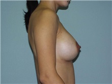 Breast Augmentation After Photo by Richard Greco, MD; Savannah, GA - Case 2633