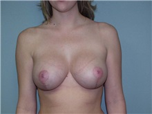 Breast Augmentation After Photo by Richard Greco, MD; Savannah, GA - Case 2671