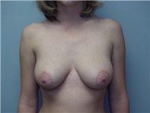 Breast Augmentation Before Photo by Richard Greco, MD; Savannah, GA - Case 2671