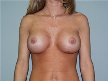 Breast Augmentation After Photo by Richard Greco, MD; Savannah, GA - Case 2742