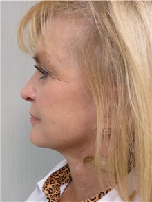 Facelift After Photo by Richard Greco, MD; Savannah, GA - Case 30632