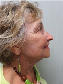 Facelift After Photo by Richard Greco, MD; Savannah, GA - Case 30641