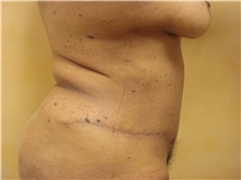 Tummy Tuck After Photo by Richard Greco, MD; Savannah, GA - Case 30645