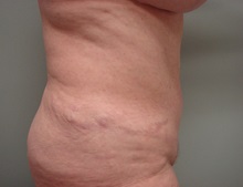 Tummy Tuck After Photo by Richard Greco, MD; Savannah, GA - Case 30646