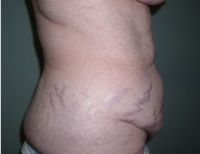 Tummy Tuck Before Photo by Richard Greco, MD; Savannah, GA - Case 30646