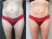 Liposuction Before Photo by Richard Greco, MD; Savannah, GA - Case 30647