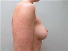 Breast Augmentation Before Photo by Richard Greco, MD; Savannah, GA - Case 30649
