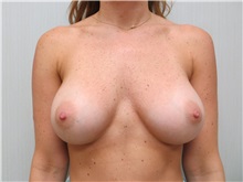 Breast Augmentation After Photo by Richard Greco, MD; Savannah, GA - Case 30650