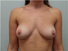 Breast Augmentation Before Photo by Richard Greco, MD; Savannah, GA - Case 30650