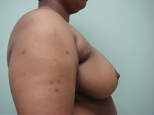 Breast Reduction After Photo by Richard Greco, MD; Savannah, GA - Case 30652